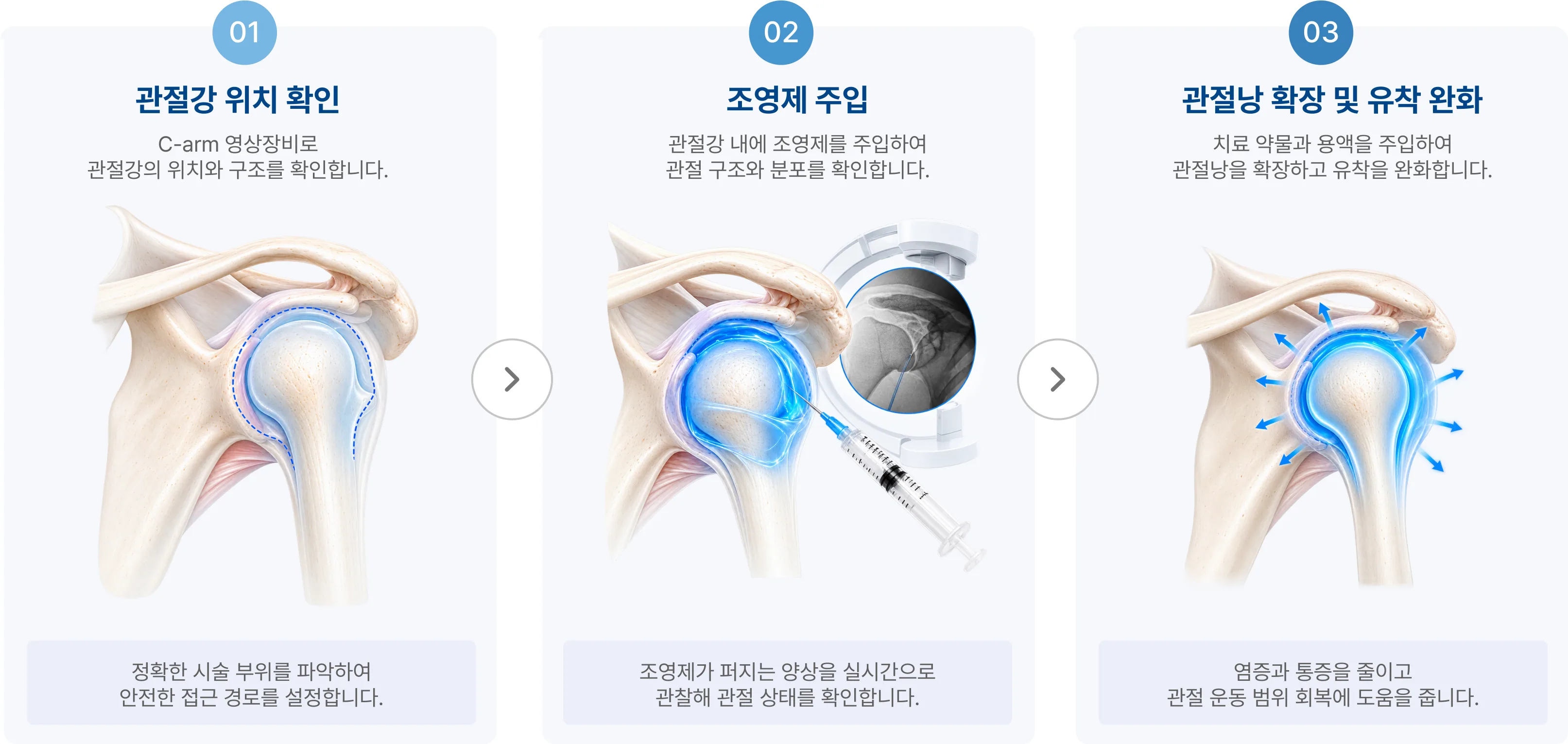 시술 과정 3단계: 01 관절강 위치 확인, 02 조영제 주입, 03 관절낭 확장 및 유착 완화