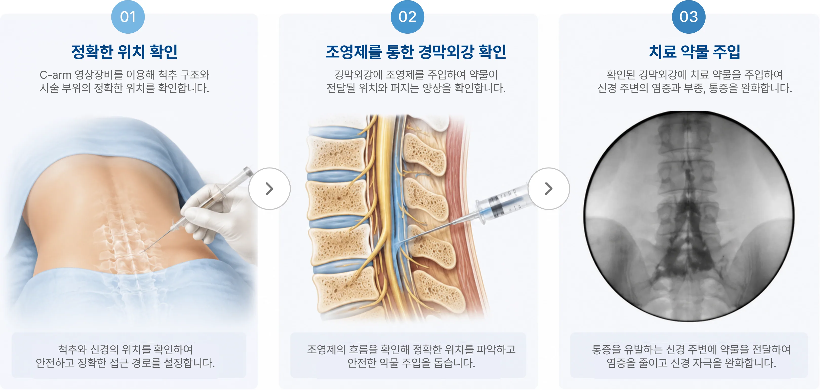 시술 과정 3단계: 01 정확한 위치 확인, 02 조영제를 통한 경막외강 확인, 03 치료 약물 주입