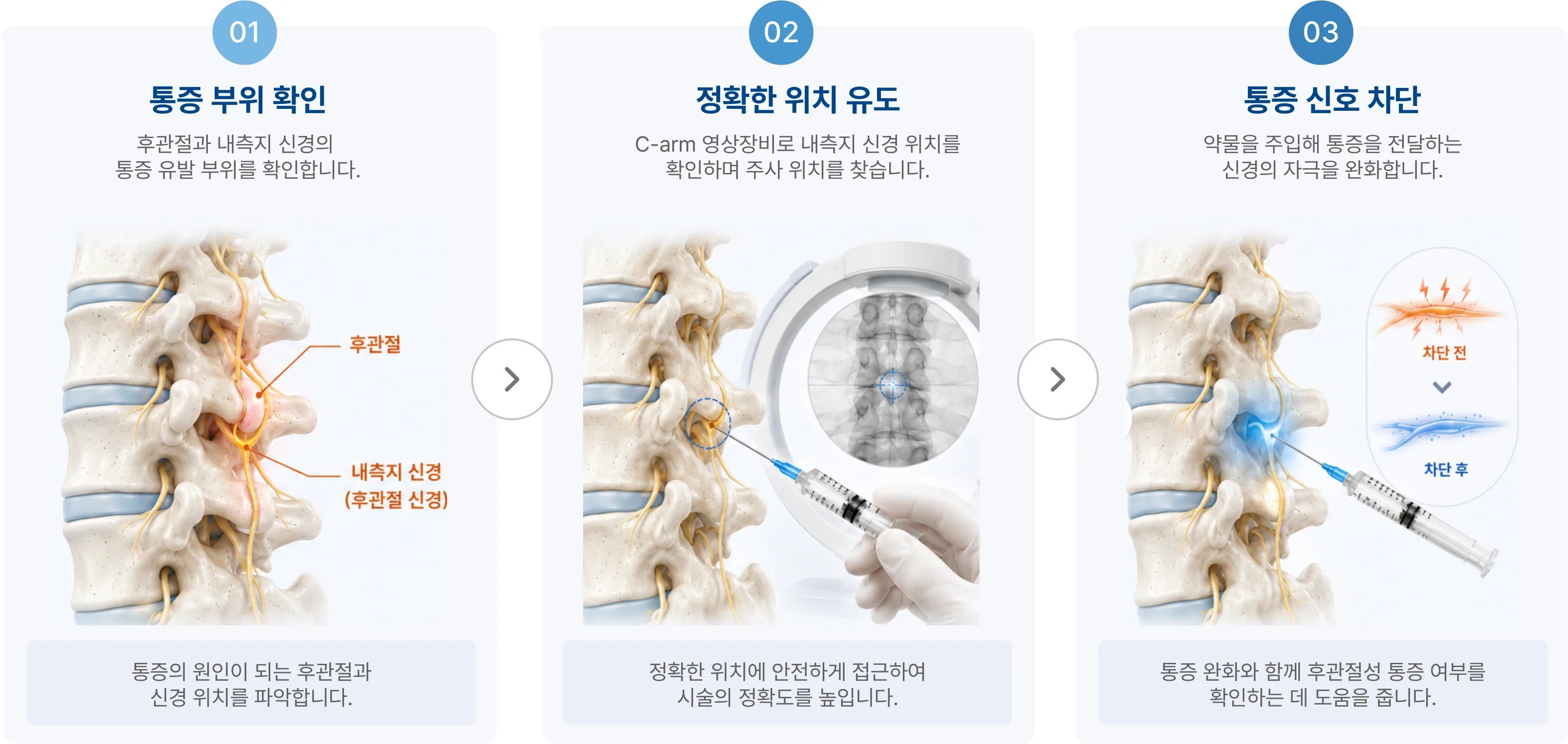시술 과정 3단계: 01 통증 부위 확인, 02 정확한 위치 유도, 03 통증 신호 차단